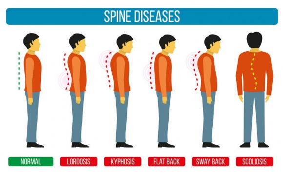 背骨のカーブの無秩序;脊柱側彎症、前彎、kyphosis、flatback